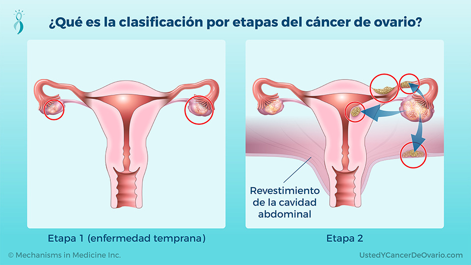 Presentación de diapositivas Comprender el cáncer de ovario