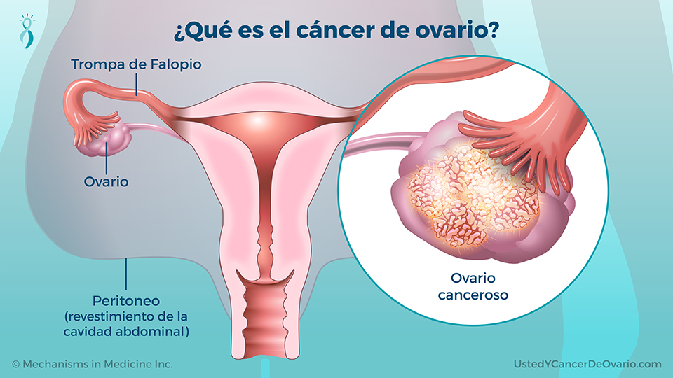 ¿Qué es el cáncer de ovario?